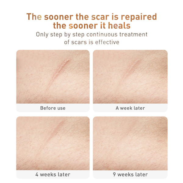 Traditional Medicine Scar Removal Cream